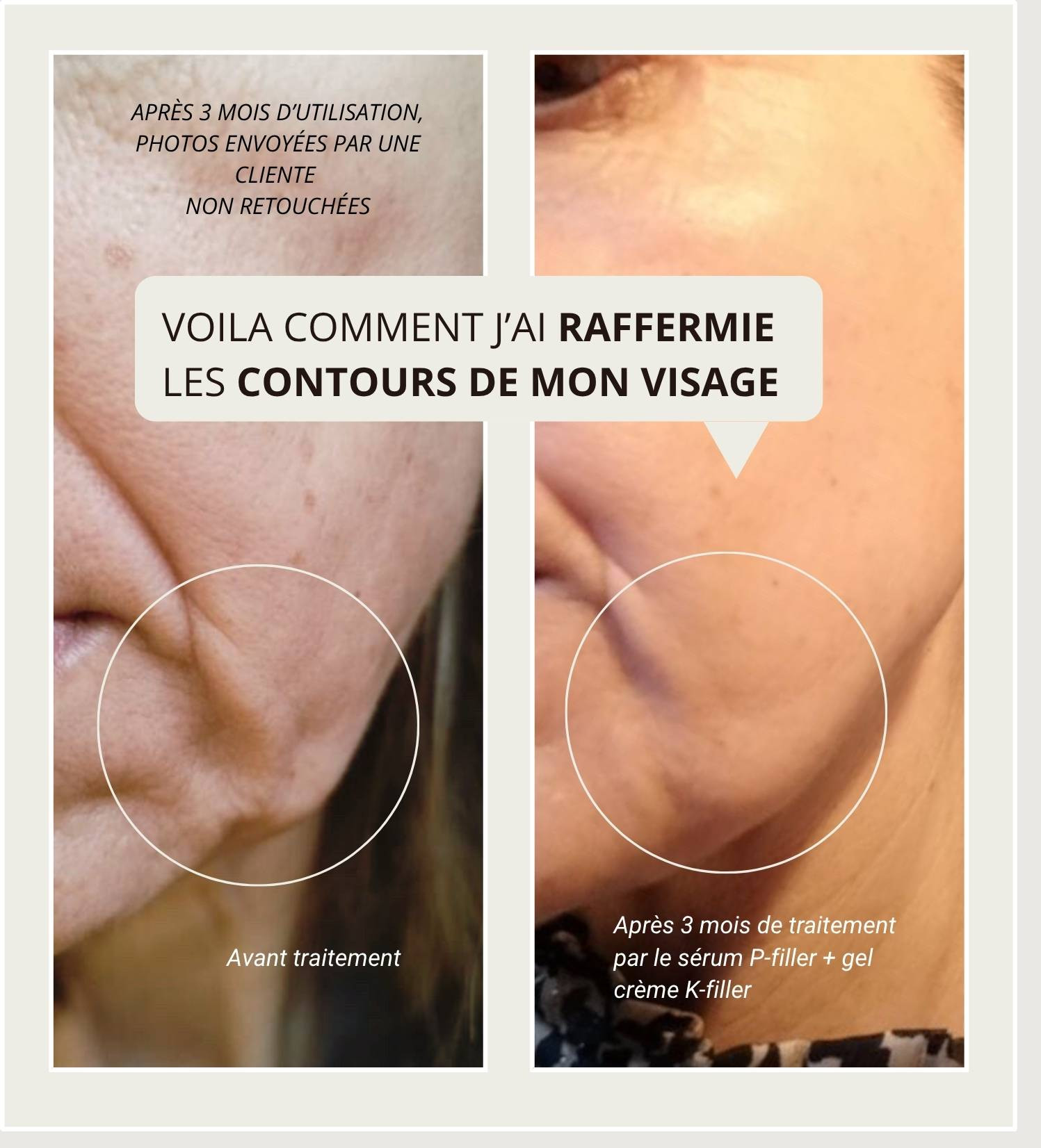 avant après traitement fermeté peptides matrixyl acide hyaluonqiue